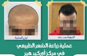 مركز اوركيد هير لزراعة الشعر