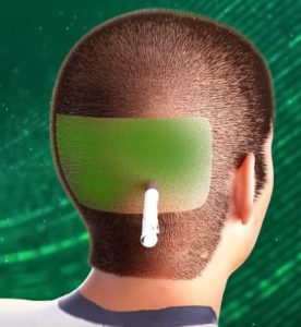 مرحلة تخدير المنطقة المانحة قبل زراعة الشعر في مصر