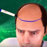 مرحلة رسم خط الشعر الامامي قبل زراعة الشعر في مصر