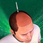 شق القنوات لزراعة الشعر بالاقتطاف