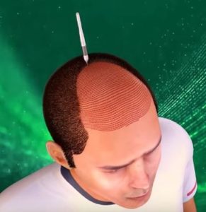 شق القنوات لزراعة الشعر بالاقتطاف