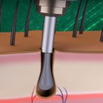 مرحلة اقتطاف البصيلات لزراعة الشعر بالاقتطاف