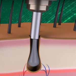 مرحلة اقتطاف البصيلات لزراعة الشعر بالاقتطاف