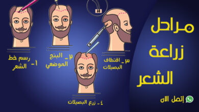 مراحل زراعة الشعر